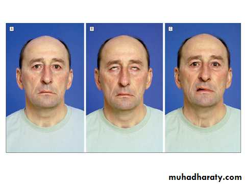 Cranial nerves disorders