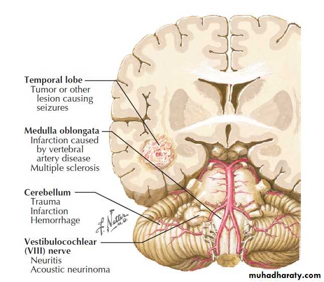 Cranial nerves disorders