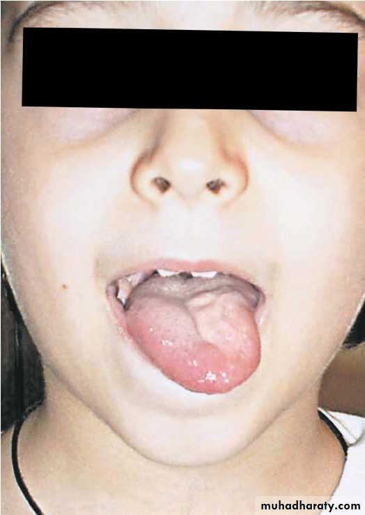 Cranial nerves disorders