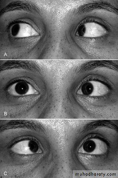 Cranial nerves disorders