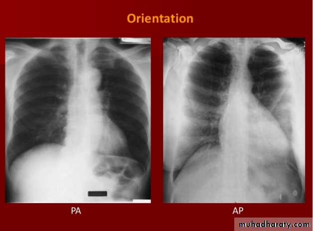 Chest C-ray