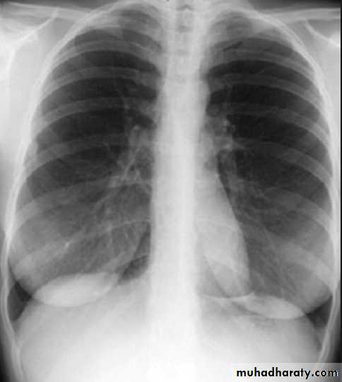 Chest C-ray