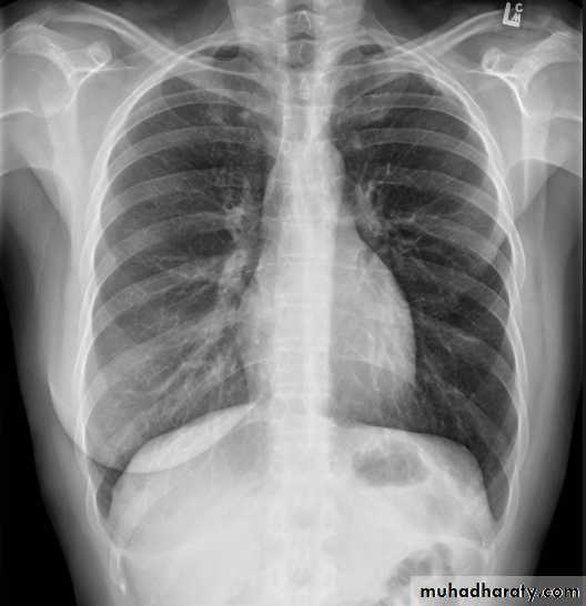 Chest C-ray