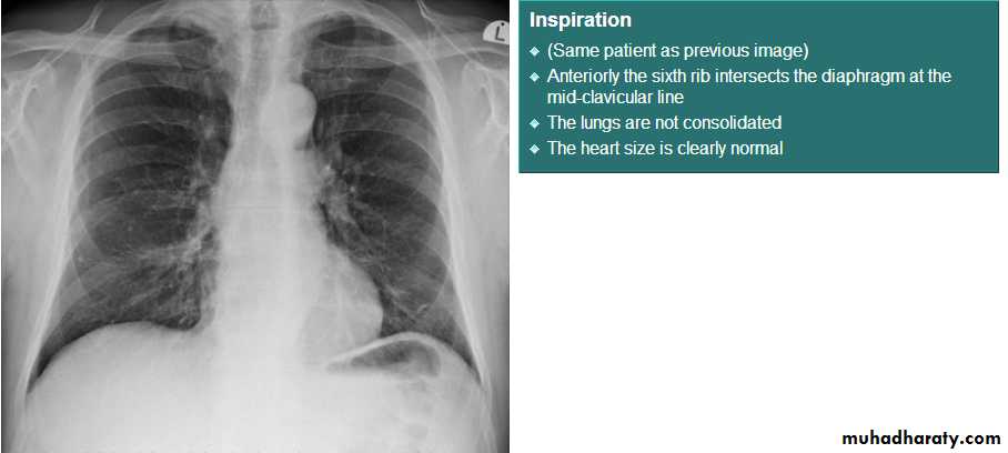 Chest C-ray