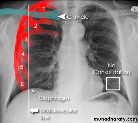 Chest C-ray