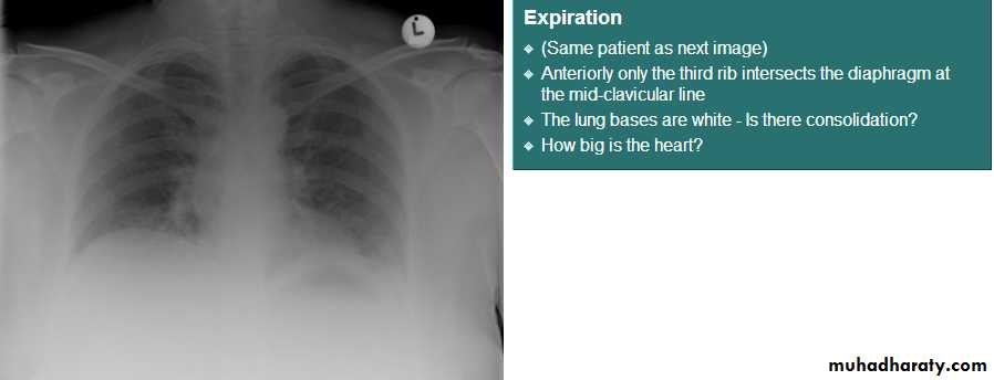 Chest C-ray