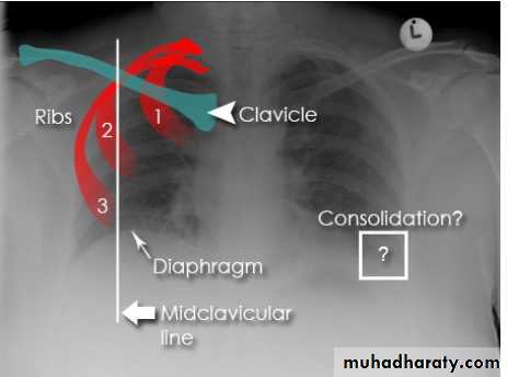 Chest C-ray