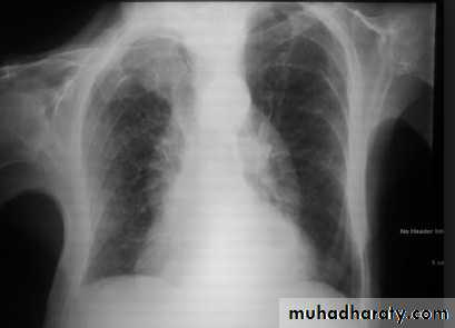 Chest C-ray