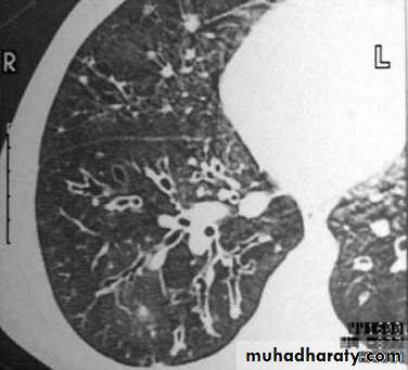 Chest C-ray