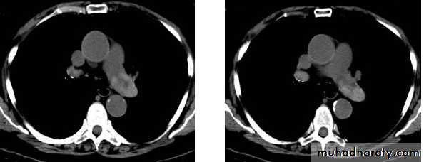 Chest C-ray