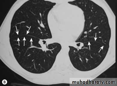 Chest C-ray