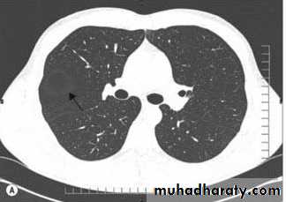Chest C-ray