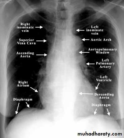 Chest C-ray