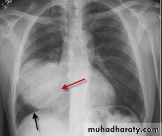 Chest C-ray