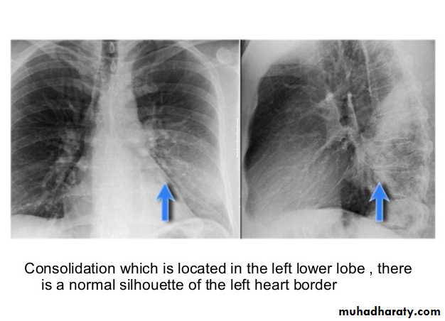 Chest C-ray
