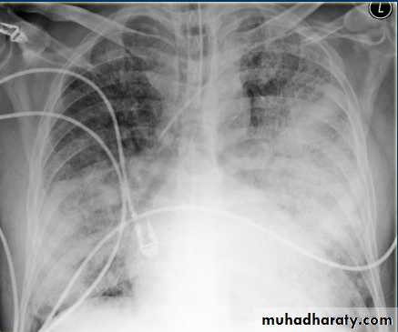 Chest C-ray