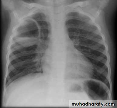 Chest C-ray