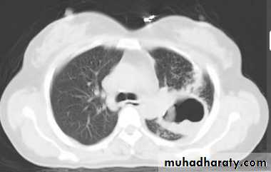 Chest C-ray