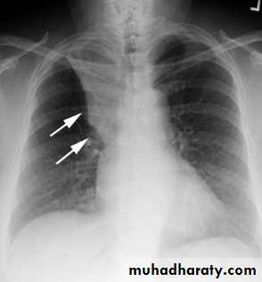 Chest C-ray