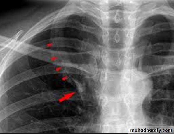 Chest C-ray
