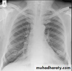 Chest C-ray