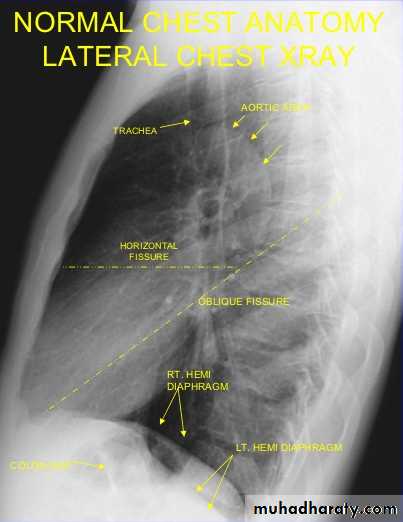 Chest C-ray