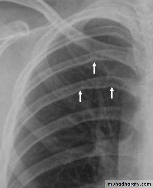 Chest C-ray
