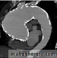 Mediastinum