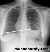 Mediastinum