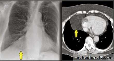 Mediastinum