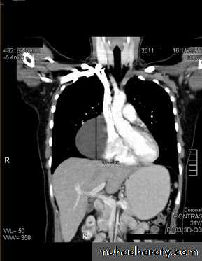 Mediastinum