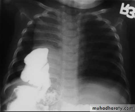 Mediastinum