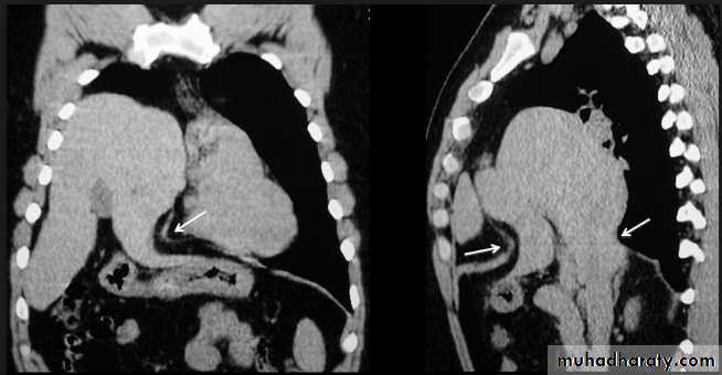 Mediastinum