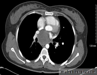 Mediastinum