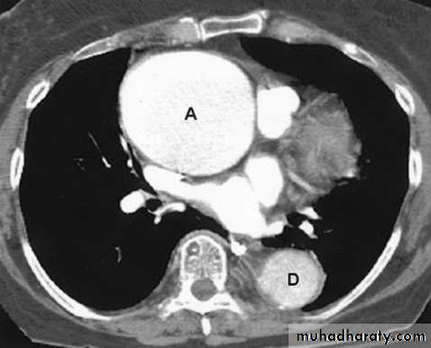 Mediastinum