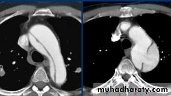 Mediastinum