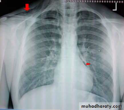 Mediastinum