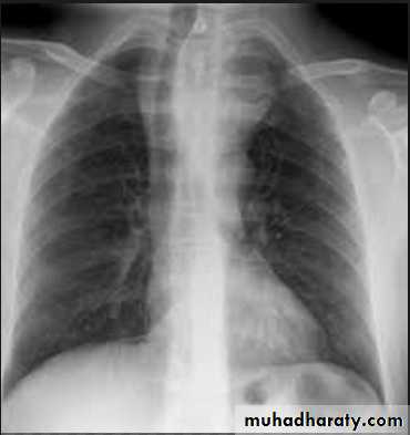 Mediastinum