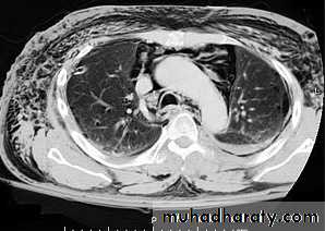 Mediastinum