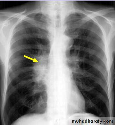 Mediastinum
