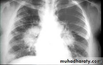 Mediastinum