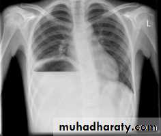 Mediastinum