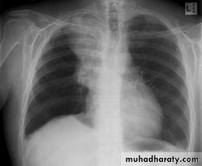 Mediastinum