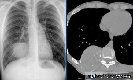 Mediastinum