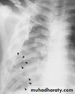 Mediastinum