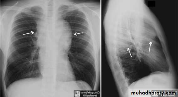 Mediastinum