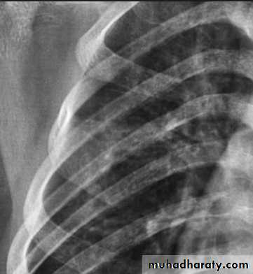 Mediastinum