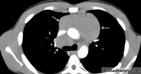 Mediastinum