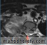 Mediastinum