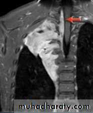 Mediastinum